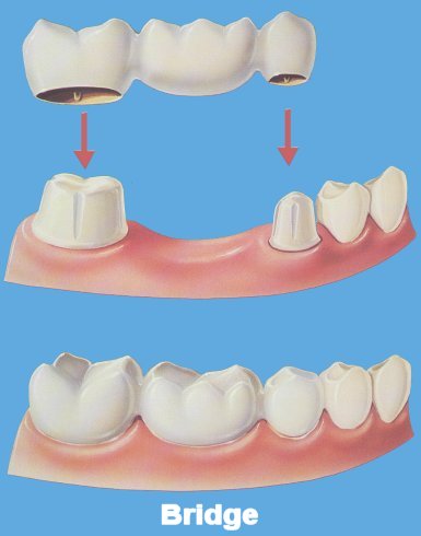 Dental Bridges and Teeth Crowns