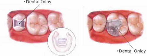 Dental Bridges and Teeth Crowns